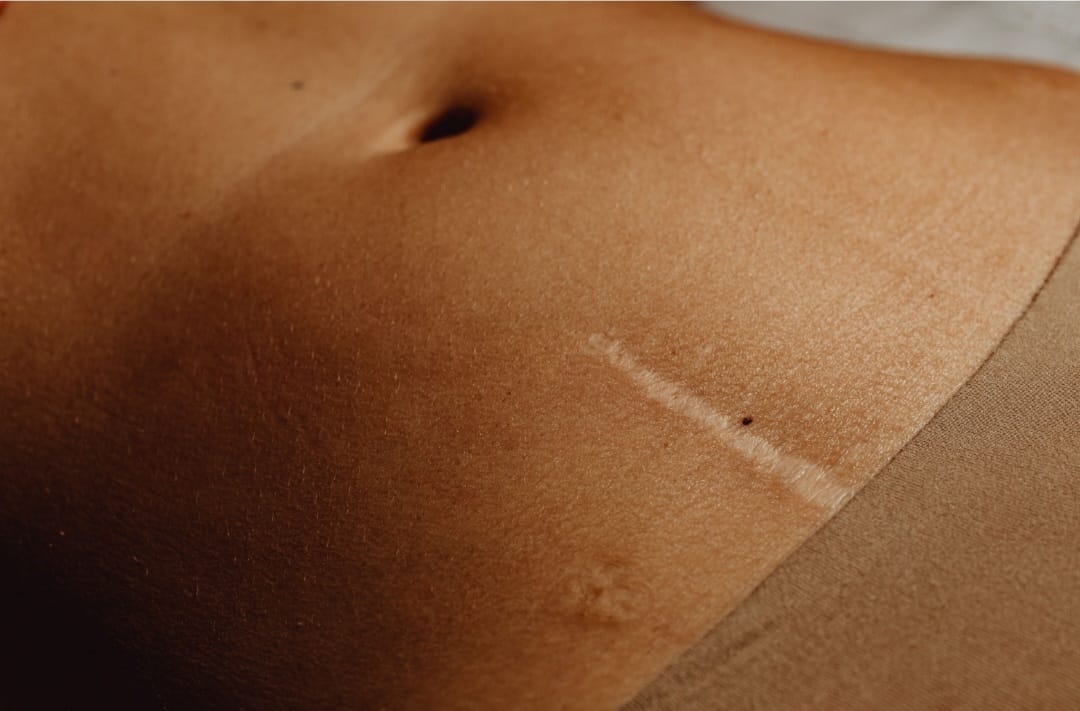 Queloides: tratamiento para cicatrices anómalas